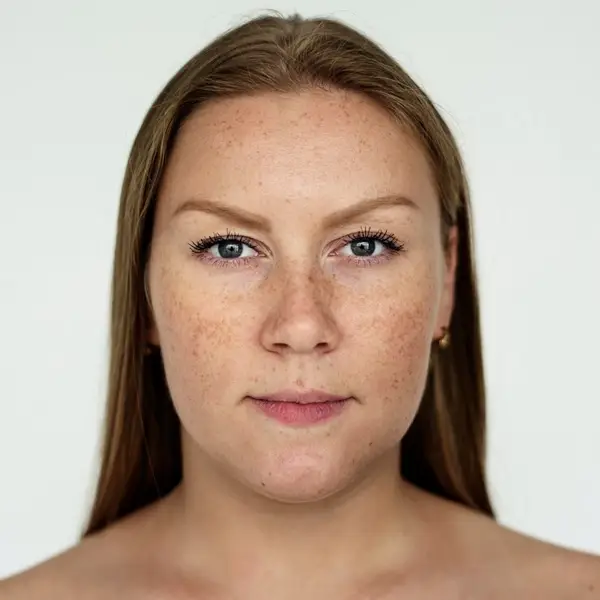 Melasma (Cilt Lekeleri)