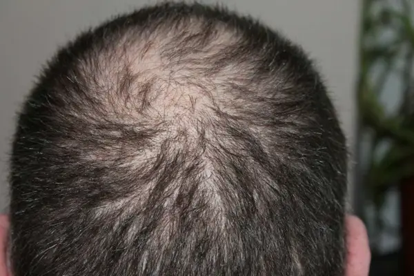 Alopesi (Saç Dökülmesi)