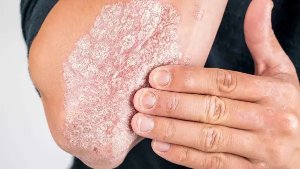 Sedef Hastalığı (Psoriasis)